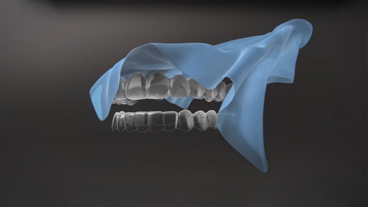 invisalign aligners cambridge overlay invisalign aligners cambridge overlay