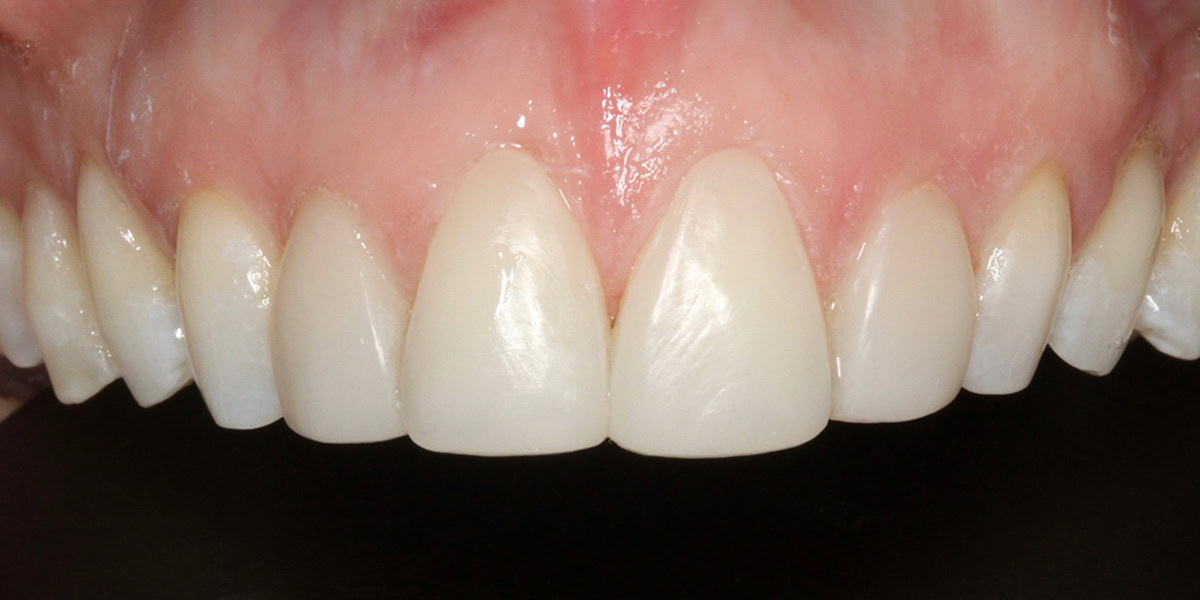 composite bonding results cambridge-after composite bonding results cambridge-after
