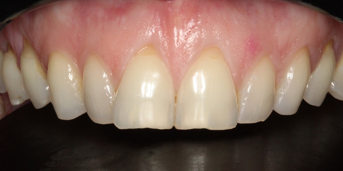 composite bonding results cambridge-before composite bonding results cambridge-before