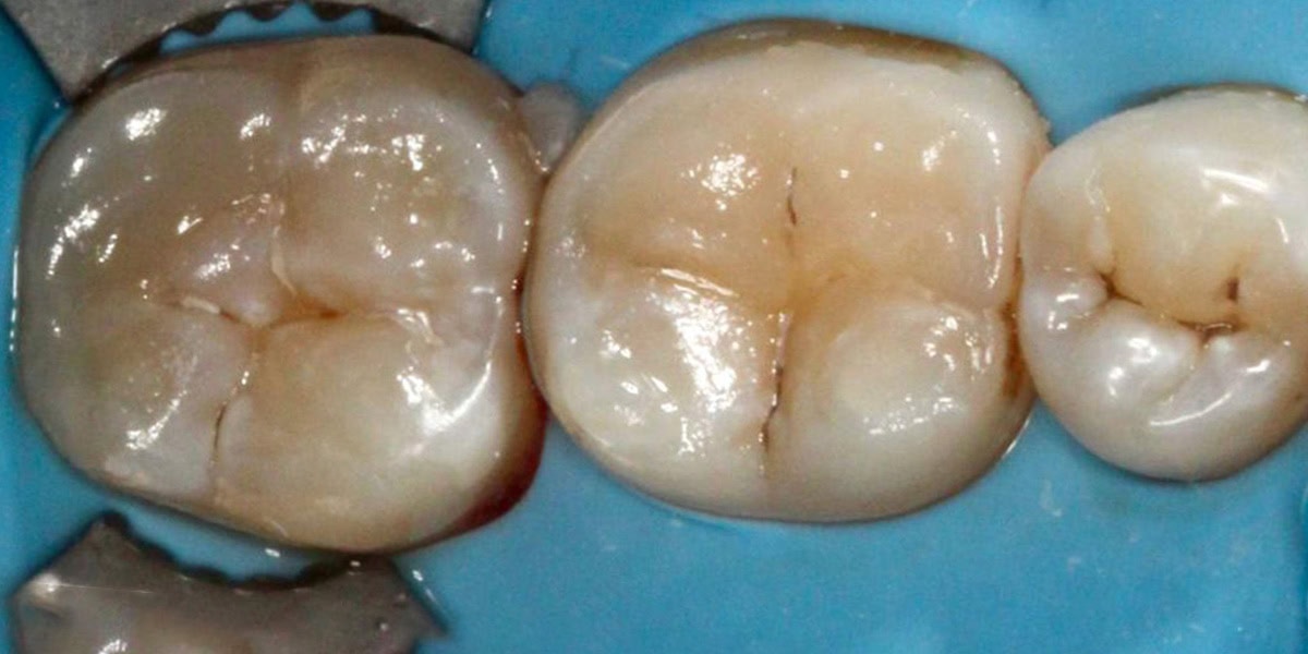 composite filling after cambridge cosmetic dentist composite filling after cambridge cosmetic dentist