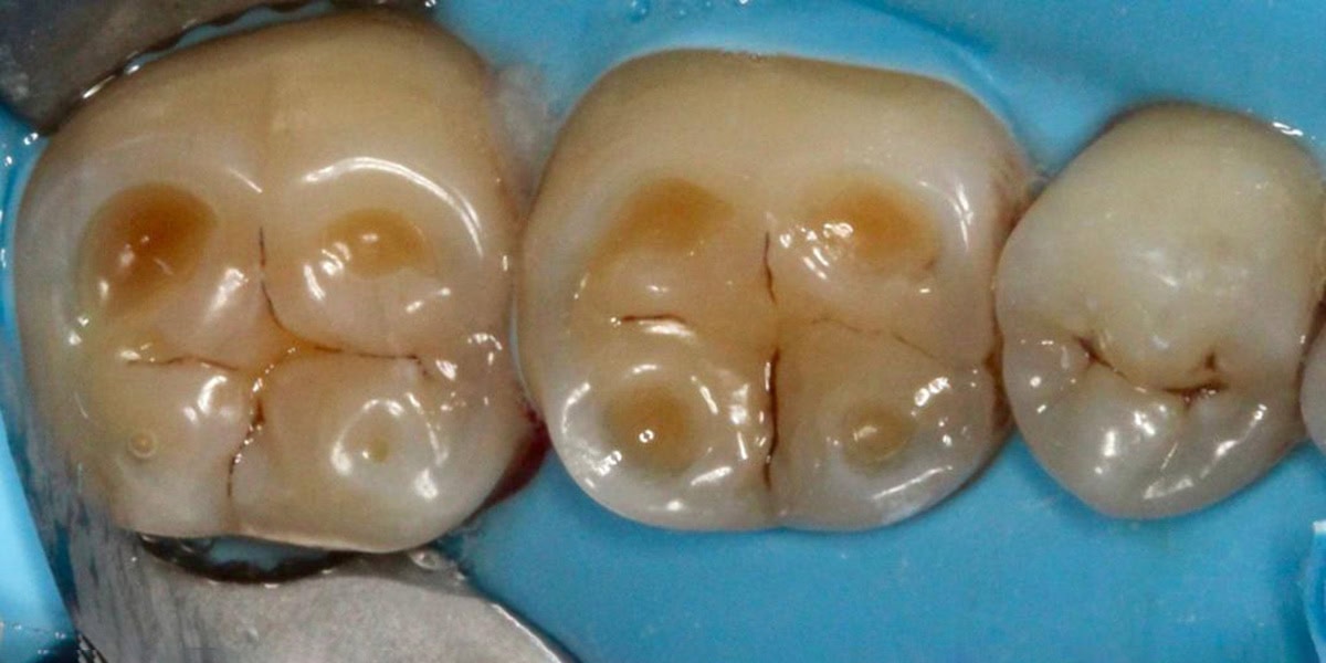 composite filling before cambridge cosmetic dentist composite filling before cambridge cosmetic dentist