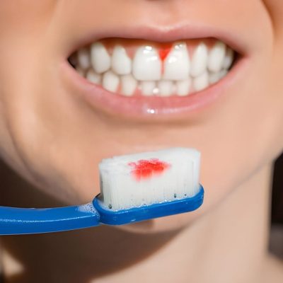 understanding gum disease cambridge dentist
