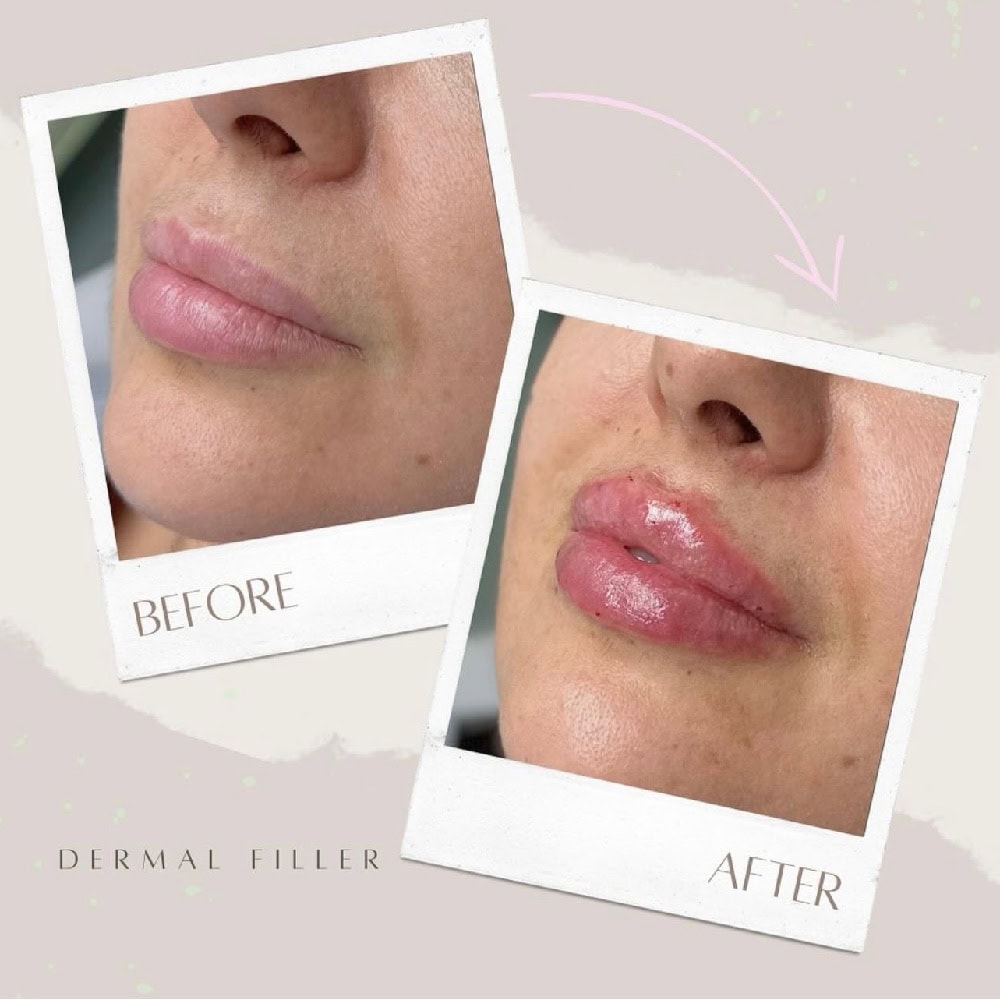 dermal fillers cambridge dentist dermal fillers cambridge dentist