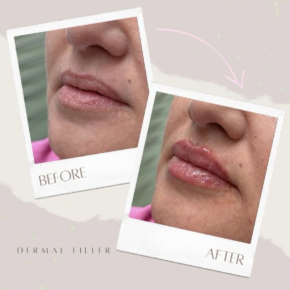 dermal fillers cambridge dermal fillers cambridge