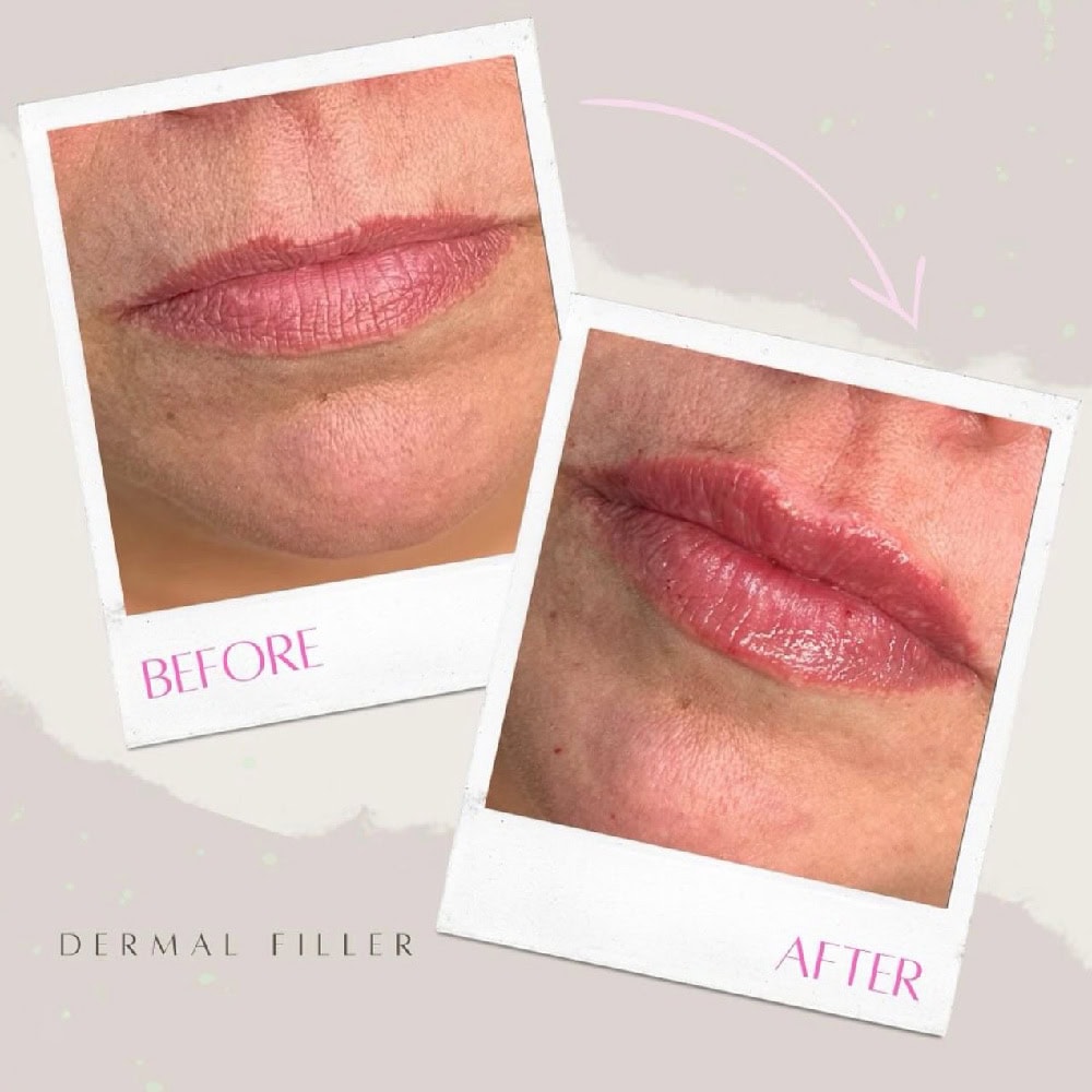 dermal fillers facial aesthetics cambridge dentist dermal fillers facial aesthetics cambridge dentist